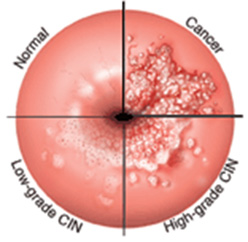 Abnormal Cervix Shape